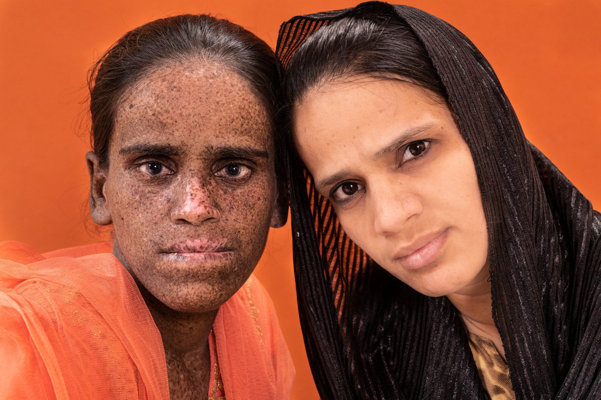 IhabFathiSulima's tweet photo. #Xeroderma #pigmentosum (XP) هو اضطراب وراثي تقل فيه القدرة على إصلاح تلف الحمض النووي مثل الضرر الناتج عن الأشعة فوق البنفسجية (UV).  قد تشمل الأعراض حروق الشمس الشديدة بعد بضع دقائق فقط من التعرض للشمس ونمش في المناطق المعرضة للشمس وجفاف الجلد وتغيرات في تصبغ الجلد. https://t.co/kzKQWAOVjr