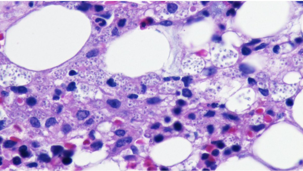 HemepathUTSW tweet media