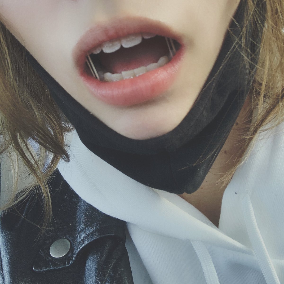 ゴムついた( ˙꒳​˙  )

矯正終盤 コロナの間で終わるかな⸜(๑⃙⃘'ᵕ'๑⃙⃘)⸝