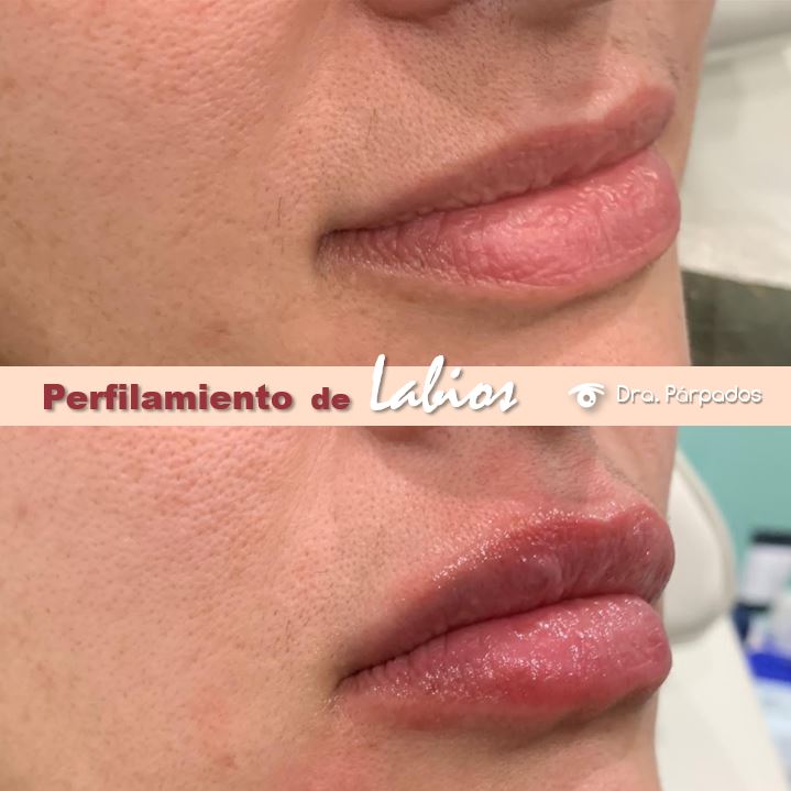 Con el perfilado se redefine la forma de los labios, trabajando el contorno labial, dándole una forma adecuada a las proporciones y anatomía del rostro con resultados naturales y estéticos. Sus efectos, dependiendo de cada paciente, pueden durar hasta 8 meses.