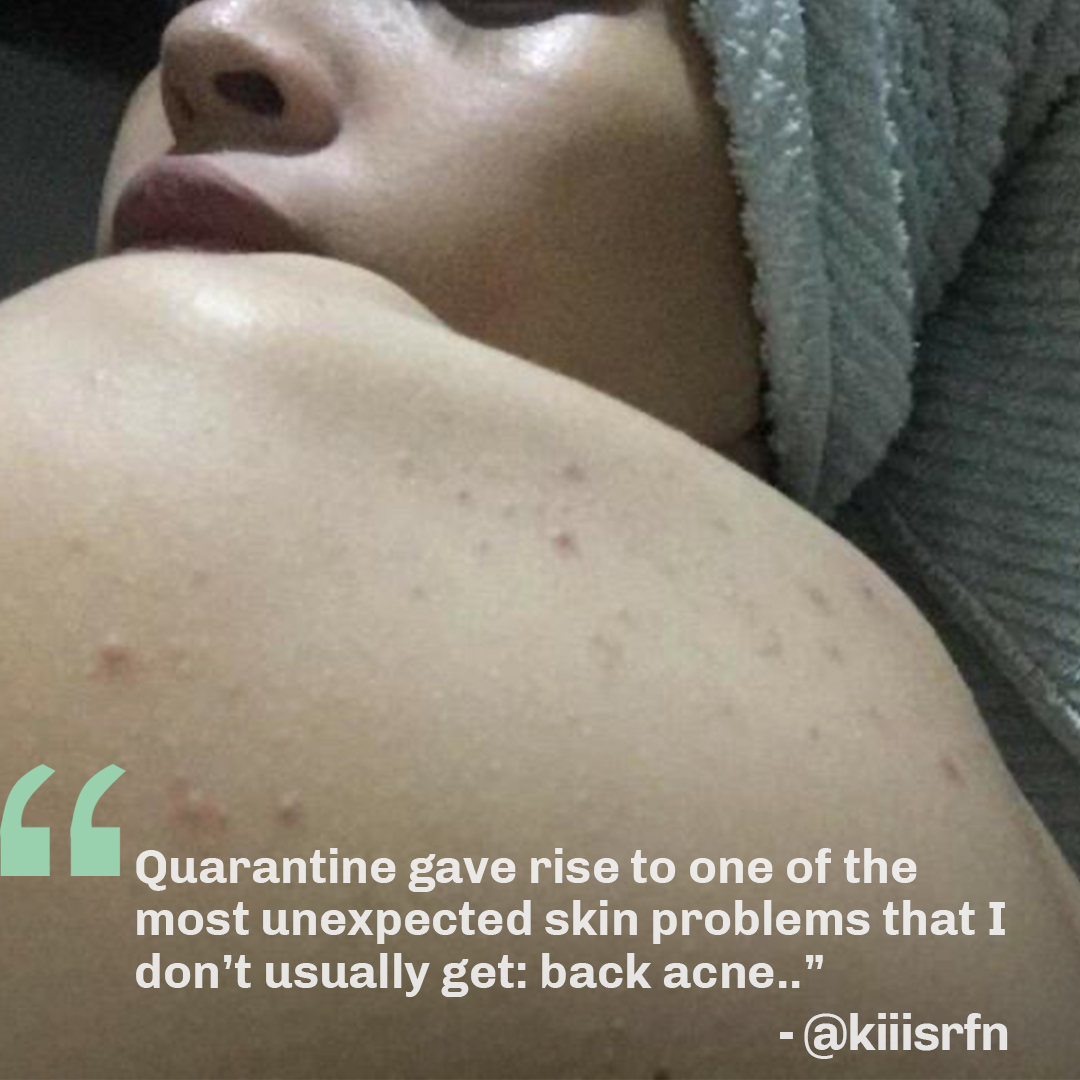 Oxecure_PH's tweet photo. “Quarantine gave rise to one of the most unexpected skin problem: back acne.” Luckily, she found the perfect product that made a difference on her sensitive skin! 💚 Keep an eye out on what she had to say 👀 #OxecureStories #SkinUnfiltered https://t.co/4fffsIv710