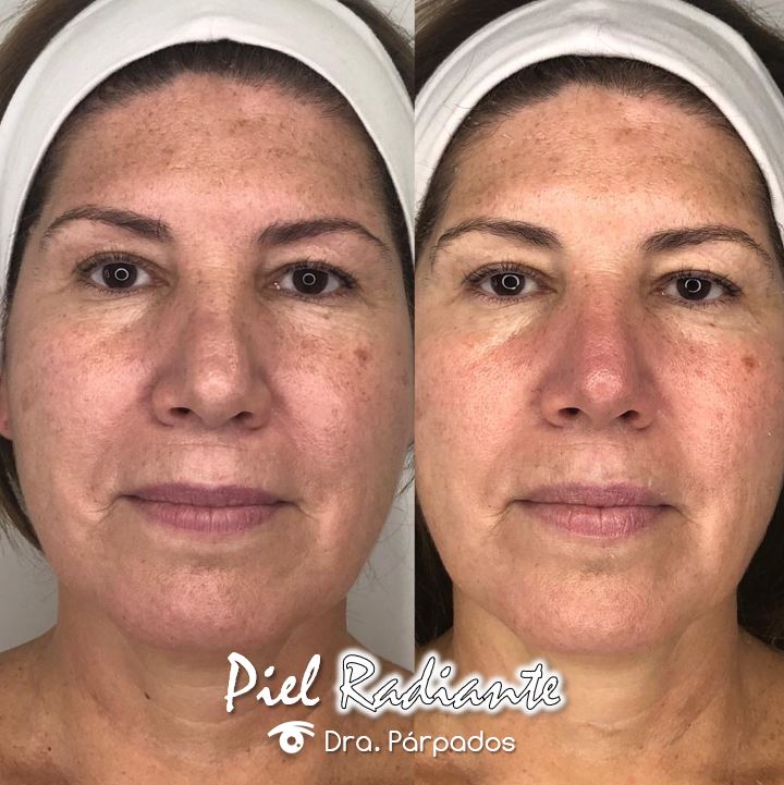 Consiente la piel de tu rostro con este tratamiento que te rejuvenecerá. Más información en USA al cel: 7543172731. En Vzla llamar al 04266575683