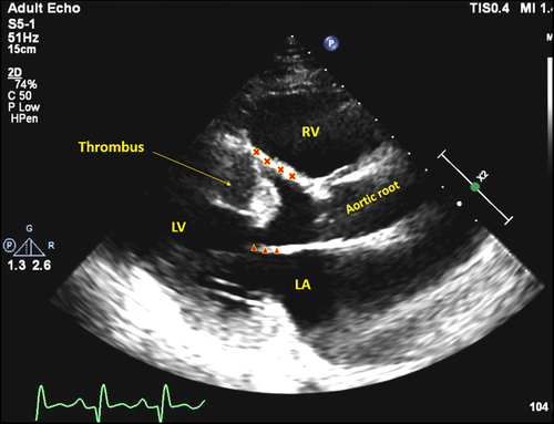 New in JACEP Open: Use of point‐of‐care ultrasound to diagnose an alternate cause of flank pain in a patient with presumed renal colic.
#FOAM, #POCUS, #FlankPain
buff.ly/35va78B
@EmergencyDocs, @ACEPNow