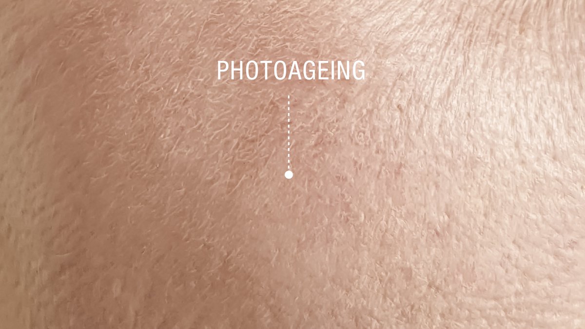 Photoageing is caused by exposure to UV radiation and is responsible for over 90% of skin ageing. The good news is that with the correct combination of dermatological #skinresurfacing treatments and homecare products we can treat and correct typical signs of ageing

#antiageing