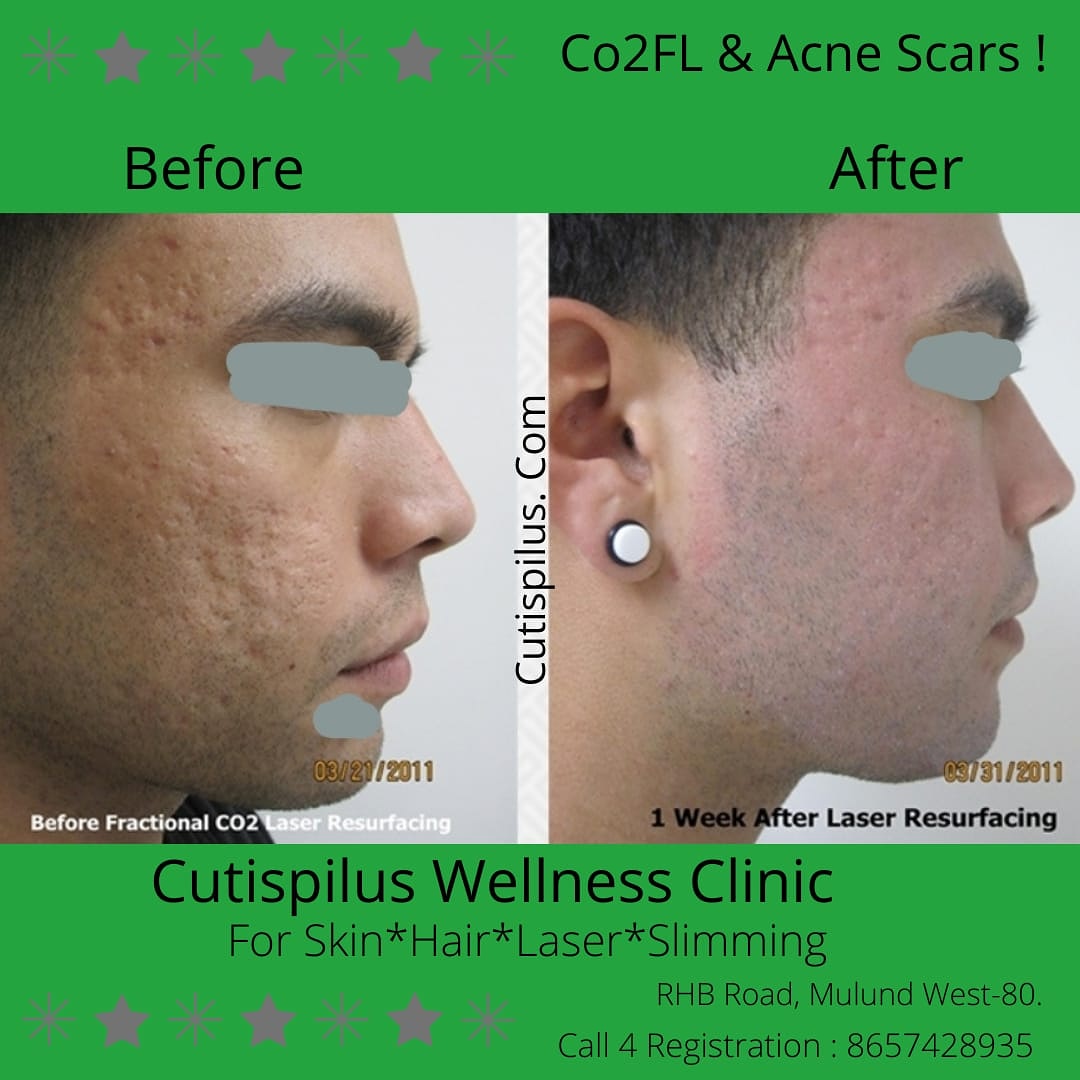CUTISPILUS's tweet photo. #skincare #skincareroutine #skins #skin #acnesolution #acnes #acne @CUTISPILUS on 23rd Jan 21 @4pm. Call for an appointment on 86574 28935. https://t.co/leFhicIB0W