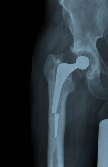 BoneJointJ's tweet photo. 👩‍🏫Ortho Quiz👩‍🏫

A 64-year-old gentleman presents with a history of pain in his thigh four years following a total hip replacement. This is his radiograph.

What is the mode of failure of this implant?

#orthoquiz #radiograph #orthotwitter https://t.co/oo4oAcKpjY