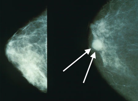 ideasinmedicine's tweet photo. Early breast cancer data uncovers racial health disparities in comorbidities like obesity – and how a diagnosis is an opportunity for lifestyle interventions that could prolong survival. @BariatricNews 

#obesity #oncology #comorbidity #bariatricsurgery 

https://t.co/11OuxpW4Ts https://t.co/su63LgYErx