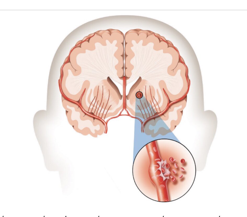 Инсульт после травмы. Геморрагический инсульт головного мозга. Причины геморрагического инсульта головного мозга.