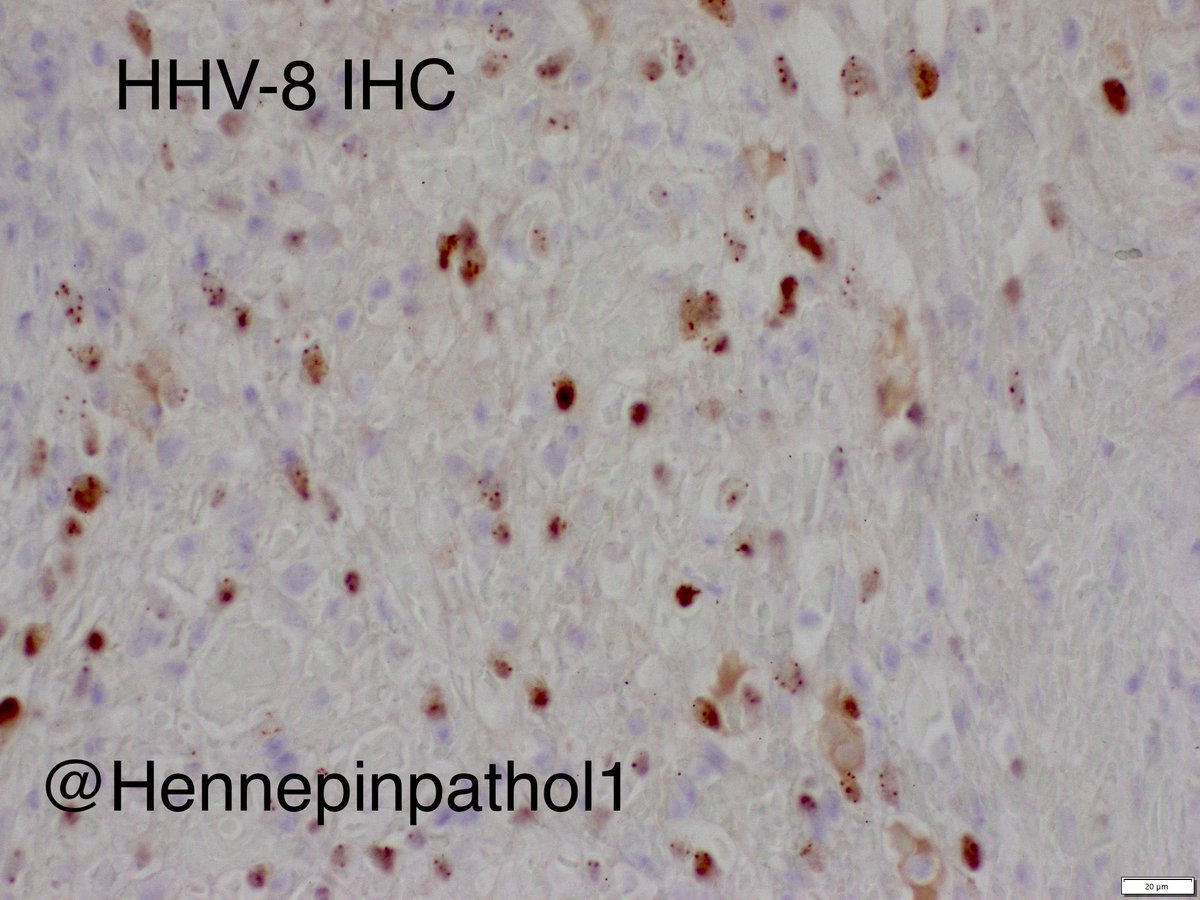 Hennepin Healthcare Lab and Pathology (@hennepinpathol1) on Twitter photo Case of the week✅ Kaposi Sarcoma✅💎caused by HHV8 virus 🦠💡seen in immunodeficiency like HIV patients 💡vascular lesion💡RBC extravasation💡spindle cells with minimal nuclear atypia #BSTpath <a href="/MayoClinicPath/">Mayo Clinic Pathology</a> <a href="/ac_pathgal/">Aastha Chauhan</a> <a href="/MelanieBoisMD/">Melanie Bois</a> <a href="/pembeoltulu/">Pembe Oltulu, MD</a> #pathology <a href="/sam_albadri/">Sam Albadri, M.D., M.Sc.</a> 👇 Case of the week✅ Kaposi Sarcoma✅💎caused by HHV8 virus 🦠💡seen in immunodeficiency like HIV patients 💡vascular lesion💡RBC extravasation💡spindle cells with minimal nuclear atypia #BSTpath <a href="/MayoClinicPath/">Mayo Clinic Pathology</a> <a href="/ac_pathgal/">Aastha Chauhan</a> <a href="/MelanieBoisMD/">Melanie Bois</a> <a href="/pembeoltulu/">Pembe Oltulu, MD</a> #pathology <a href="/sam_albadri/">Sam Albadri, M.D., M.Sc.</a> 👇