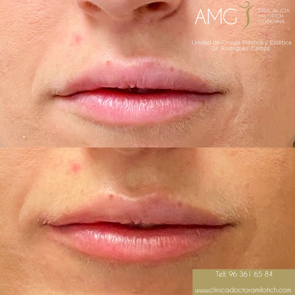 DraMilotich's tweet photo. En la actualidad existen tratamientos para recuperar la tersura, el volumen y forma #labial 👄 según las necesidades de cada paciente.

El tratamiento consiste en inyectar 💉 acido #hialurónico tanto en la región peribucal para mejorar la #Piel , #arrugas peribucales y perfilado. https://t.co/xeXNKELVhv