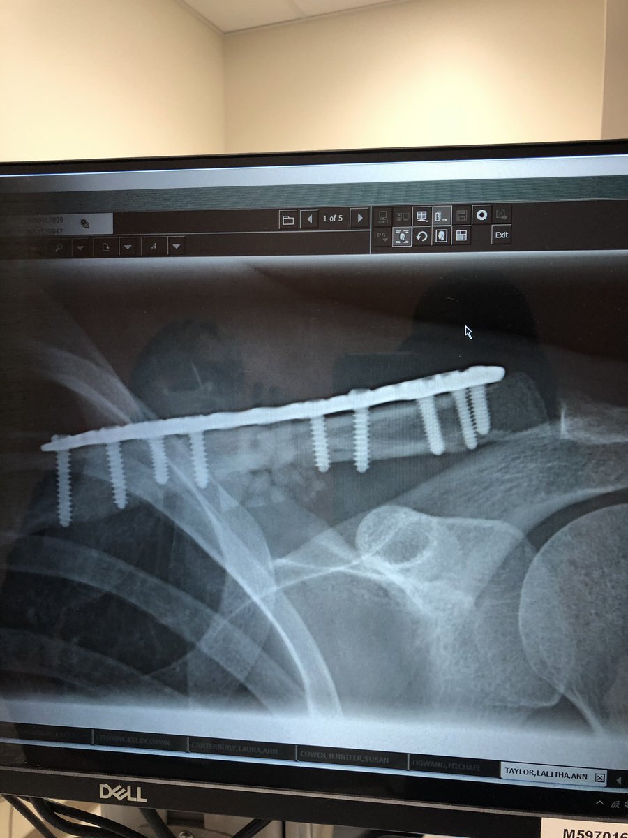 9 screws and 1 steel plate later. 

It’s been a long journey towards recovery. Grateful for my surgeon and exceptional staff at the U of A hospital.