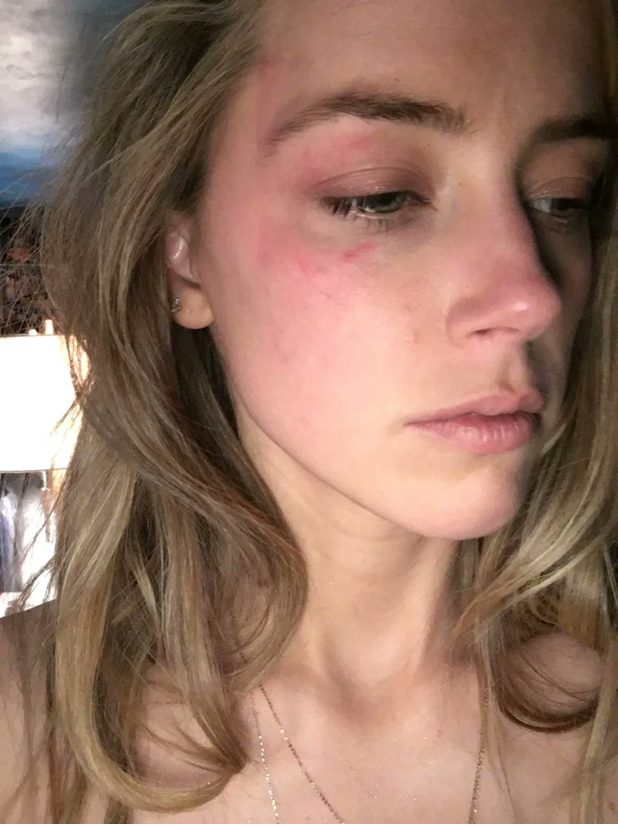 On May 21, 2016 Amber claims Johnny Depp threw an iPhone at her face "like a baseball pitcher" and that she thought her eye popped out. There is no redness or swelling to the area of her eyeball at all and many people around their building and home say nothing was on her face