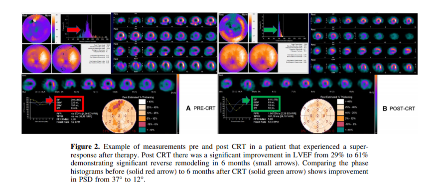 JNCjournal's tweet photo. #JournalNC: Absence of CAD, diabetes mellitus &amp; hypertension are independently associated with CRT super-responder status after CRT determined by functional class &amp; #SPECT MPI phase histogram SD.

👉Learn more: https://t.co/dbnnAFTHgj
📻Listen here: https://t.co/1VlHg6gKS7
#CVNuc https://t.co/ckYxbtbtv9