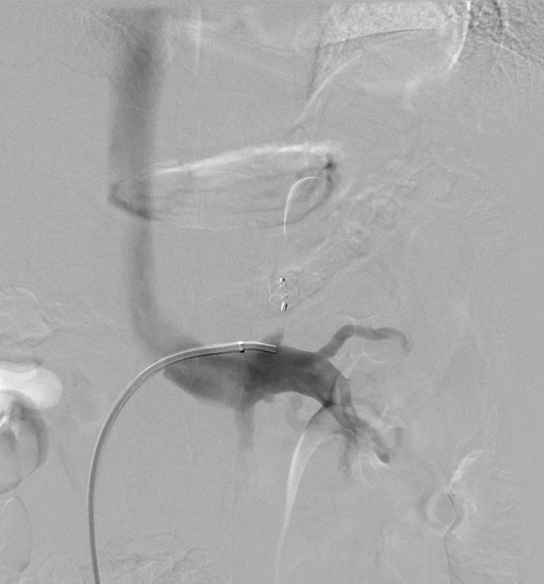 NshRadiology's tweet photo. #VascularPlug Occlusion Retrograde Transvenous Obliteration for the case of isolated #GastricVarices ... Aethoxyslerol 2 % foam was used ... #Radiology #Intervention #IR #Makkah https://t.co/QW0J1mV51d