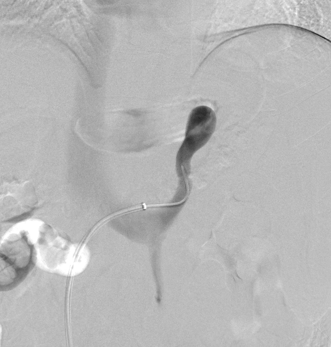 NshRadiology's tweet photo. #VascularPlug Occlusion Retrograde Transvenous Obliteration for the case of isolated #GastricVarices ... Aethoxyslerol 2 % foam was used ... #Radiology #Intervention #IR #Makkah https://t.co/QW0J1mV51d