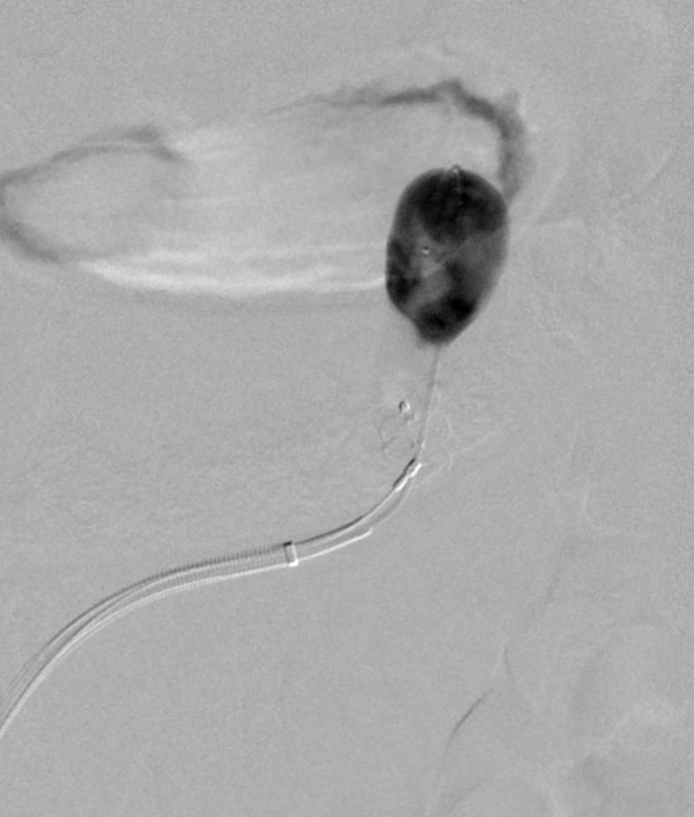 NshRadiology's tweet photo. #VascularPlug Occlusion Retrograde Transvenous Obliteration for the case of isolated #GastricVarices ... Aethoxyslerol 2 % foam was used ... #Radiology #Intervention #IR #Makkah https://t.co/QW0J1mV51d