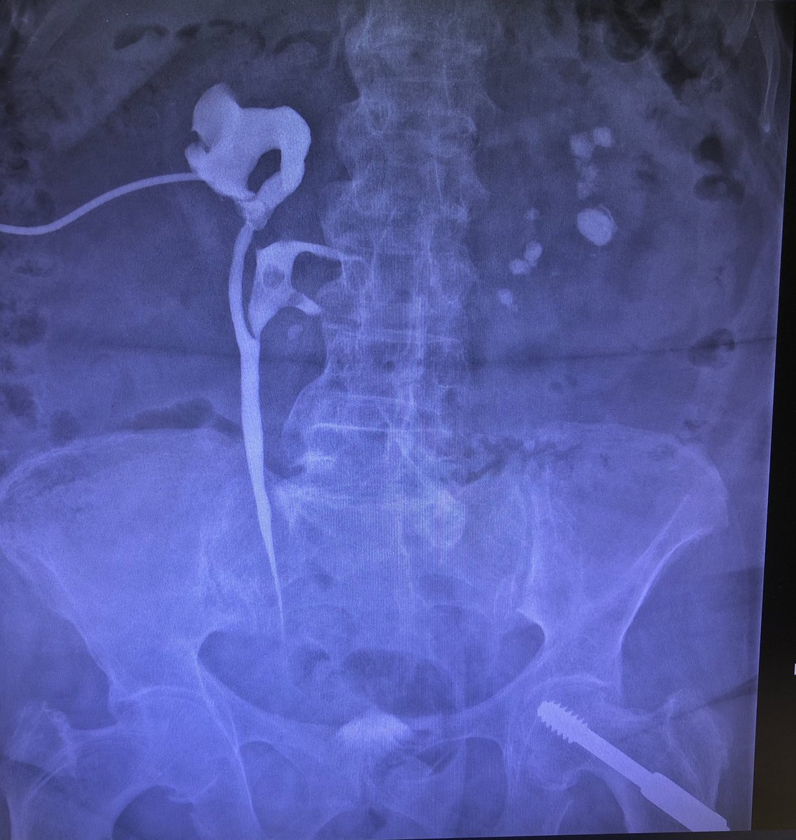 emiliani_e's tweet photo. Right bifid pelvis. What would be the other diagnosis in this patient? And proper treatment? https://t.co/VUSA7FdAhK