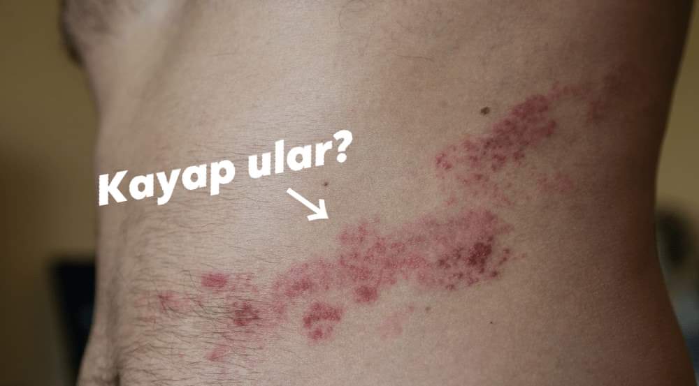 dr_chaku's tweet photo. "Doktor, betul ke kalau kena KAYAP ULAR, kalau dia bersambung keliling badan, nanti boleh mati?"

Pernah dengar tak pernyataan ni? Betul ke tidak pernyataan ni? Sebelum itu, kita lihat dahulu kayap ni penyakit apa sebenarnya. https://t.co/JRVXH5T1BH
