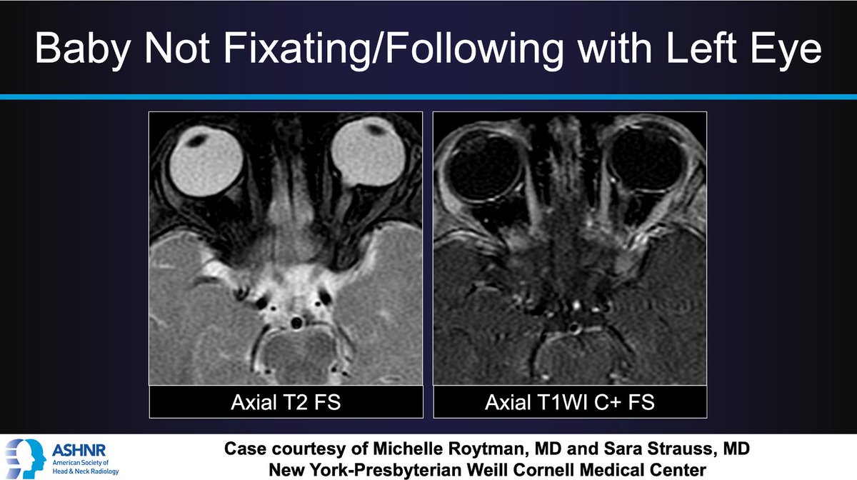 ASHNR (@ashnrsociety) on Twitter photo #ASHNRCOTW #135: Baby Not Fixating/Following with Left Eye. Dx? Thx Drs. <a href="/MichelleRoytman/">Michelle Roytman, MD</a> & <a href="/sarastrauss5/">sara strauss</a> 4 case! #ASHNR21
Answer w/ appropriate GIF only -- stay professional & don't spoil it!
<a href="/IlonaSchmalfuss/">Ilona Schmalfuss</a> <a href="/callyrobs/">Caroline Robson, MBChB</a> <a href="/DShatzkes/">Deborah Shatzkes</a> <a href="/CDP_Rad/">C Douglas Phillips 🇺🇸</a> <a href="/rhwiggins/">Richard Wiggins</a> <a href="/nakoontz/">Nicholas Koontz</a> <a href="/cmtomblinson/">Courtney Tomblinson, MD</a> #ASHNRCOTW #135: Baby Not Fixating/Following with Left Eye. Dx? Thx Drs. <a href="/MichelleRoytman/">Michelle Roytman, MD</a> & <a href="/sarastrauss5/">sara strauss</a> 4 case! #ASHNR21
Answer w/ appropriate GIF only -- stay professional & don't spoil it!
<a href="/IlonaSchmalfuss/">Ilona Schmalfuss</a> <a href="/callyrobs/">Caroline Robson, MBChB</a> <a href="/DShatzkes/">Deborah Shatzkes</a> <a href="/CDP_Rad/">C Douglas Phillips 🇺🇸</a> <a href="/rhwiggins/">Richard Wiggins</a> <a href="/nakoontz/">Nicholas Koontz</a> <a href="/cmtomblinson/">Courtney Tomblinson, MD</a>