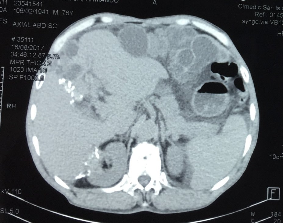 AaMolinaID's tweet photo. ¿Qué microorganismo es el agente causal más frecuente de éstos hallazgos radiográficos? @MayoClinicINFD @IdBowl #infectiousdiseases #IdCases #microbiology https://t.co/CfuvUne9SQ
