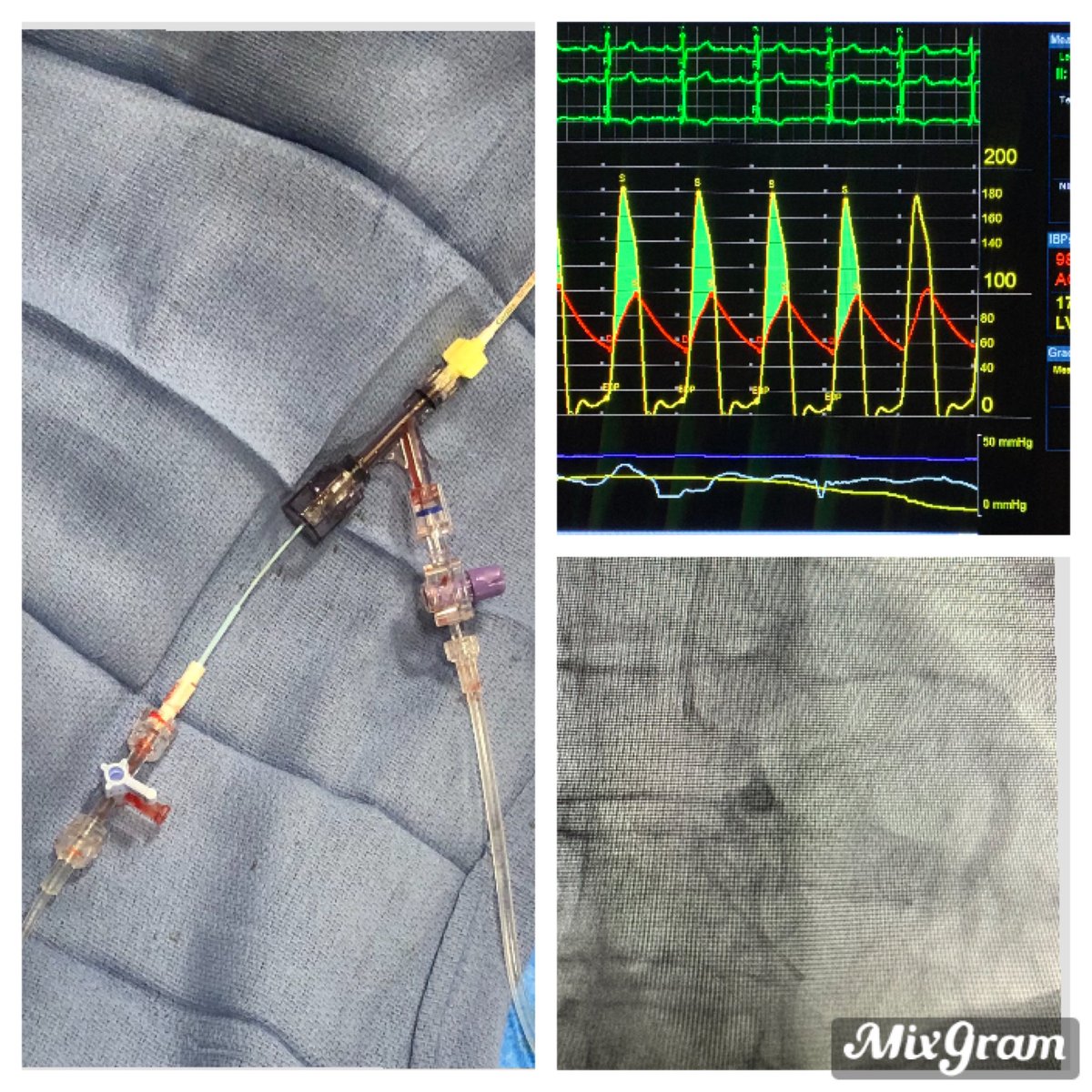 GonzalezLenguMD's tweet photo. Given the recall of dual lumen Catheters, we tried mother-in-child (6fr JR4 guiding, 125 cm MP). Good tracings. #RadialFirst approach. Thanks @Juan_Terre  for sharing this @MistyBlueMD 
@JorgeFuentesMD @abelcasso @arpitshahmd @kwancardio @RCubedduMD @pmoreno143 @TAVRBot https://t.co/4Kw83CjMtj