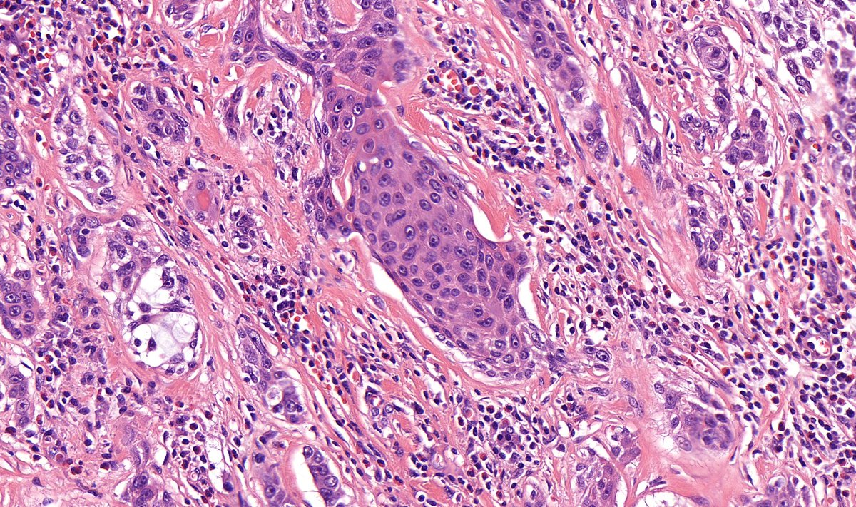 Thyroid, female adult

#ENTpath #Endopath #Surgpath #pathtwitter