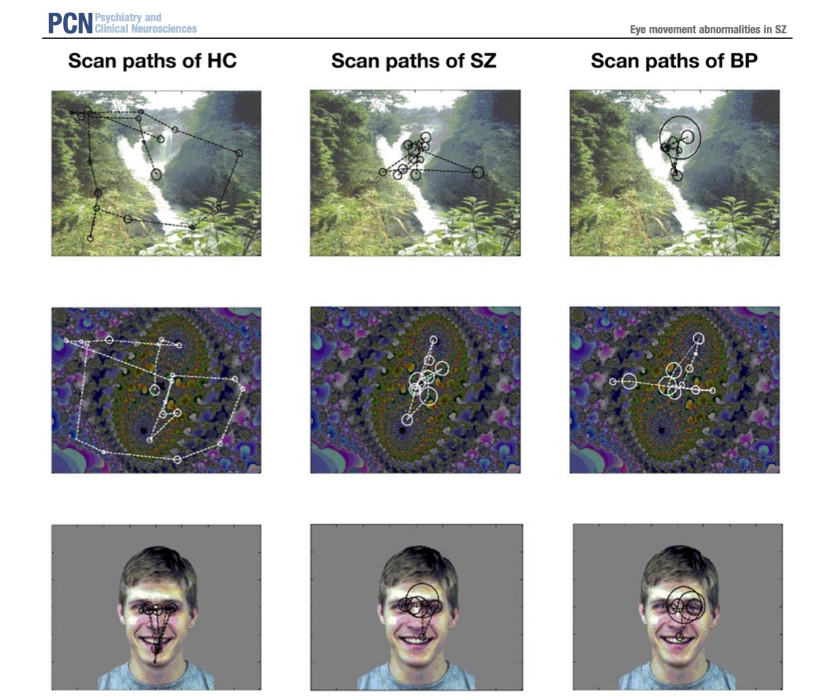 PCN_Psychiatry's tweet photo. "Recent updates of eye movement abnormalities in patients with schizophrenia: A scoping review" by Wolf & Hirano
https://t.co/vNcJu9pQrd
#Schizophrenia #biomarker #EyeMovement #EyeTrackingDysfunction #GazeMetricsParameters #VisualInformationProcessing #Review https://t.co/tamSyyABb1