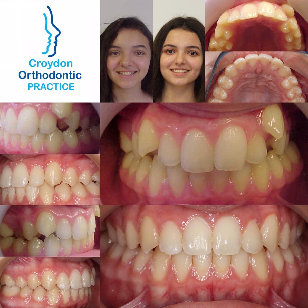 CroydonOrtho's tweet photo. 🔹🦷Before &amp; After🦷🔹 #croydonorthodontics #dentistry #dentist #croydon #orthodontics #invisalign #invisalignuk #specialistorthodontics #surrey #londoncosmetics #londonorthodontics #surreyorthodontics #cosmeticdentistry #surreydental #straightersmile #southcroydon #purley https://t.co/ZwLHArkeAr