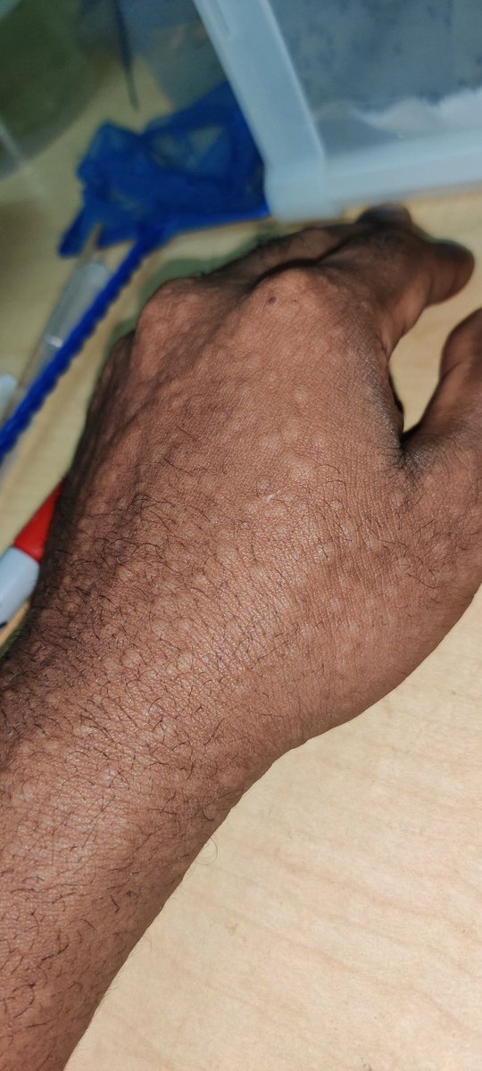 Afterwards, I had those lovely keepsakes. I had to do my best not to scratch because I wouldn't stop, but after that they were not a problem. I would even forget about them at times. Within 3 days they were all gone, only to come back when I stick my arm in again the next week 9/