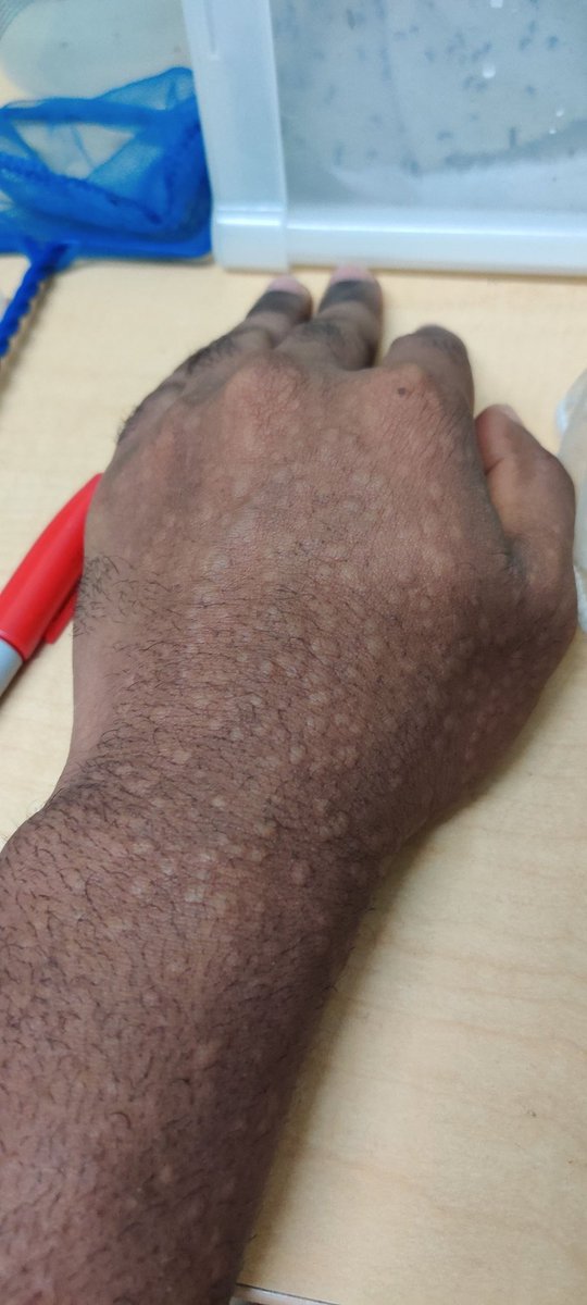 Afterwards, I had those lovely keepsakes. I had to do my best not to scratch because I wouldn't stop, but after that they were not a problem. I would even forget about them at times. Within 3 days they were all gone, only to come back when I stick my arm in again the next week 9/