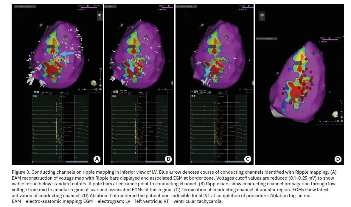 #EPeeps updates in #VTablation: ICM/NICM, pre-procedural imaging, #mapping, #ablation techniques. Campbell et al #KCJ.