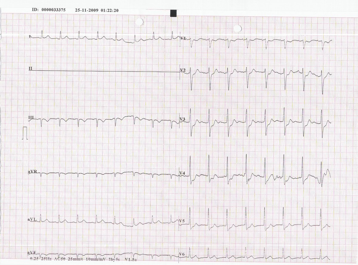 This is an old one, but wasn't shared here. The 1st ECG in the ER. The patient transferred to CCU with a diagnosis of NSTEMI and the 2nd ECG was obtained. What is happening ?