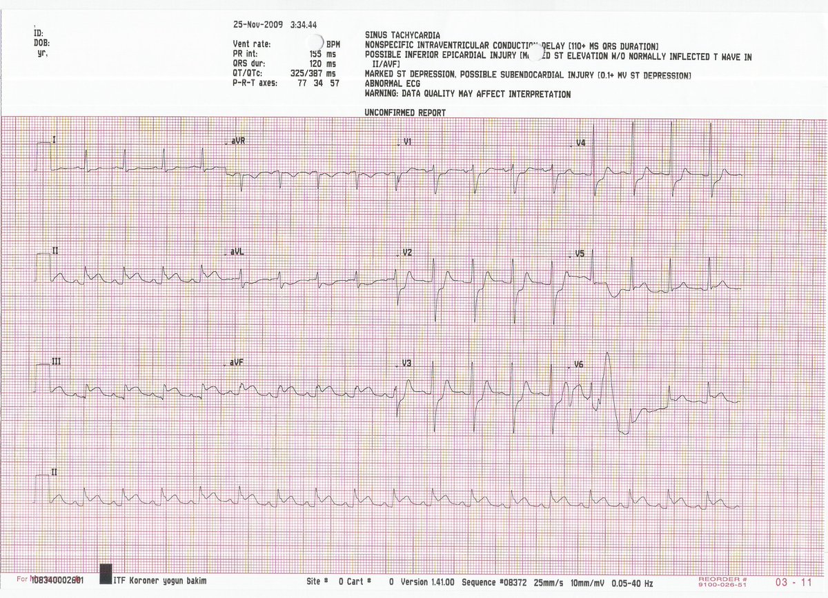 This is an old one, but wasn't shared here. The 1st ECG in the ER. The patient transferred to CCU with a diagnosis of NSTEMI and the 2nd ECG was obtained. What is happening ?