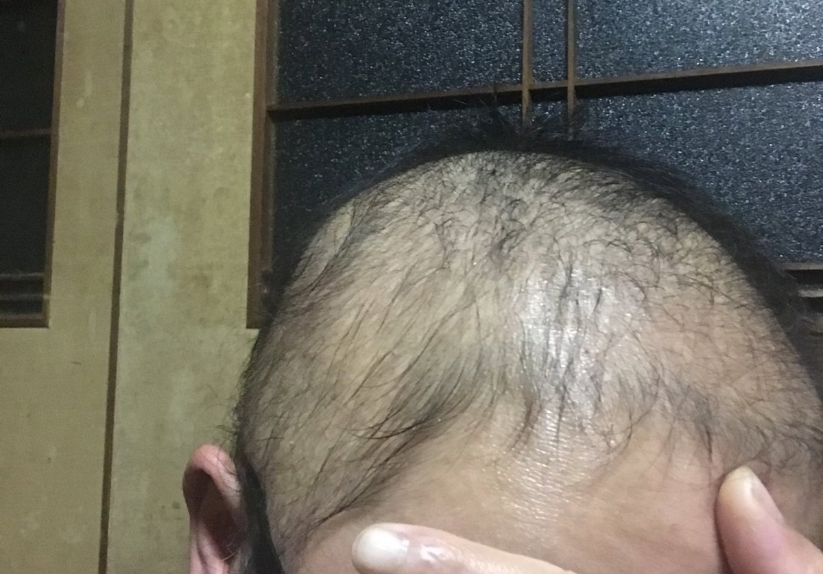 抜毛症の人と繋がりたい