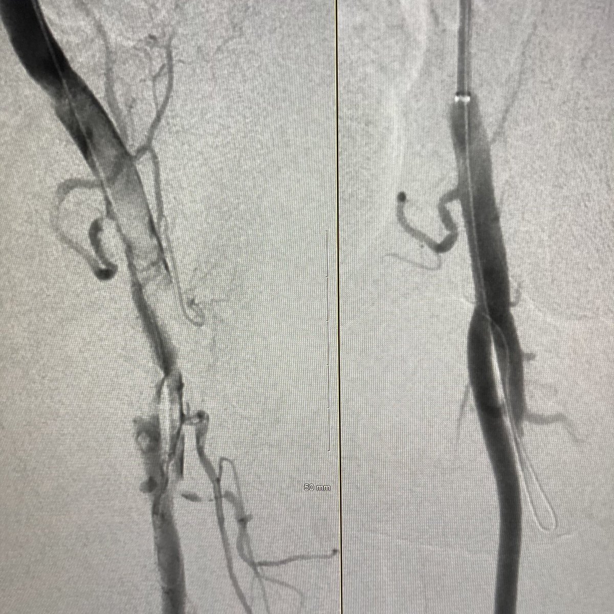JParkMD's tweet photo. #COVID patient presents with acute painful cold LLE, completely flaccid pale foot on exam, new onset #afib. Rescued with @PenVascular Lightning 8 on the CFA/SFA/profunda/pop, Cat 6 on the tibials. @PIHHealth @PIH_IR @SIRspecialists @SIRRFS @SDhandMD @p_oconnor1 @Yo_StacyJ #irad https://t.co/wEDHpYHMWV