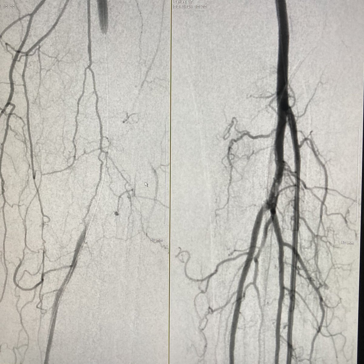 JParkMD's tweet photo. #COVID patient presents with acute painful cold LLE, completely flaccid pale foot on exam, new onset #afib. Rescued with @PenVascular Lightning 8 on the CFA/SFA/profunda/pop, Cat 6 on the tibials. @PIHHealth @PIH_IR @SIRspecialists @SIRRFS @SDhandMD @p_oconnor1 @Yo_StacyJ #irad https://t.co/wEDHpYHMWV