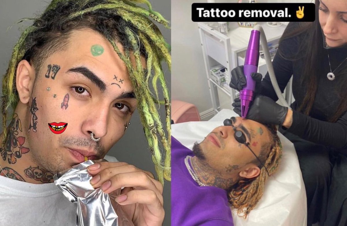 SAY CHEESE! 👄🧀 on Twitter: "Lil Pump currently the process of his face tattoos removed. https://t.co/bbFJuSONum" / Twitter