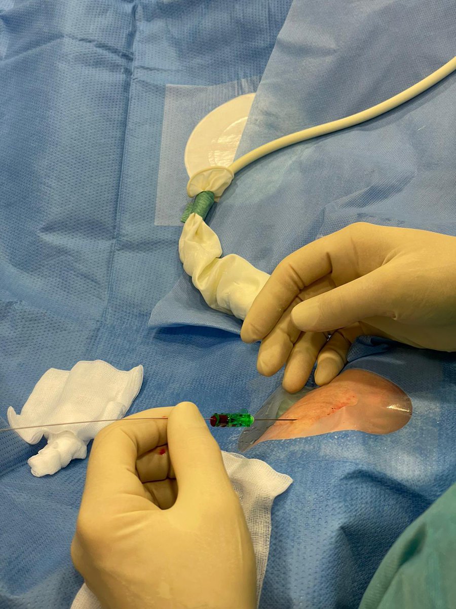 PeterGrewe3's tweet photo. #radialisfirst For #ulnarisalternativ you have to pay for transulnar success by taking a 0.014 choice pt wire to cross the distal kinking save and insert a sheed https://t.co/GCd4iDH2NW