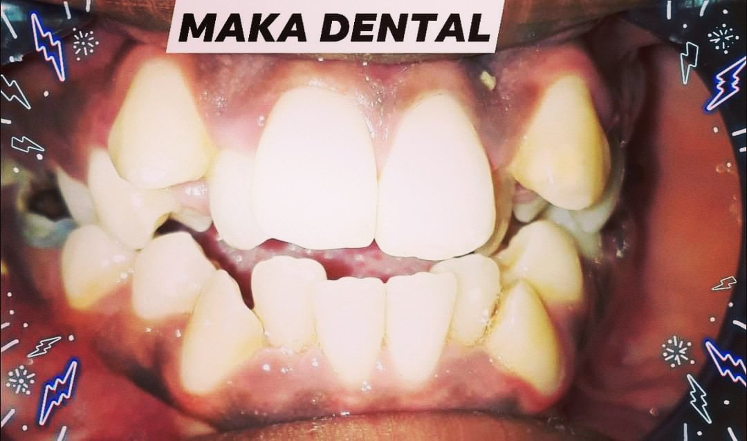 MAKADENTALCLIN1's tweet photo. Waxaan kuu xireynaa biraha kuwa ugu tayeysan uguna dhaqsiyaha badan. Waan kuu hagaajineynaa adigoon iligna lagaa saarin  hadaba horey ugaar Xarumaha Maka Dental Clinic contacts; 0906869494  +252907367384 +252616573027   +252615512168 https://t.co/8btaBYjS5j