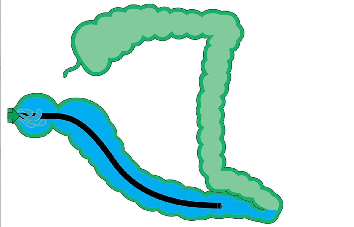 Water immersion colonoscopy 💧🔦 1️⃣ With patient in left lateral position, infuse 💧 2️⃣ 🚿 enough 💧 (>300ml) to achieve a gravitational effect. Suction air/ ⛔️💨to keep colon deflated. 3️⃣ This weighs down and shortens the sigmoid, resulting in ⬇️➿ and happier patient👍😁