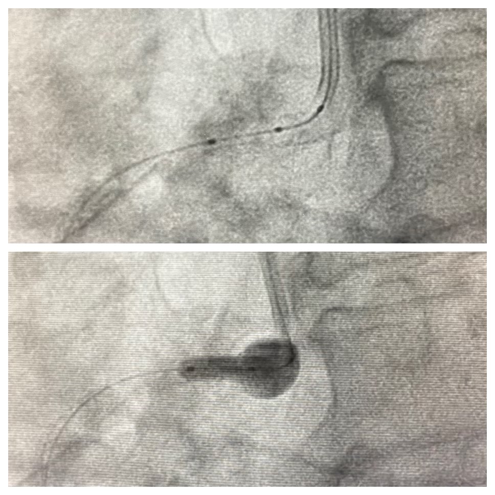 VergeMedical's tweet photo. Congratulations to Dr. Michael Azrin @uconnhealth on his initial Flash case! Perfect treatment of the ostial RCA!
#true360 #Flash @OstialFlashNYC https://t.co/rPyVOIeC8t