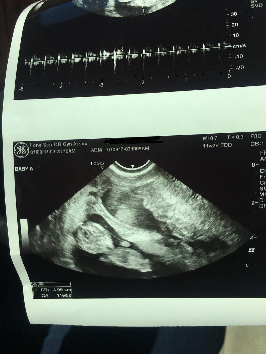 I’ve blocked my name and birthday out for privacy but that’s also not what a 15 week old fetus would look like. Here’s mine at 11 weeks