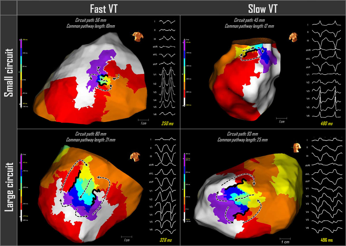 What is the principal determinant of ventricular tachycardia cycle length? Hint: it is not the dimension of the reentrant circuit. Find out here: ow.ly/jG4d50DesSt  #AHAJournals <a href="/DrRoderickTung/">Roderick Tung</a> <a href="/TakuroNishimu/">Takuro Nishimura</a> <a href="/gauravaupadhyay/">Gaurav A. Upadhyay</a> <a href="/ABeaser/">Andrew Beaser</a>