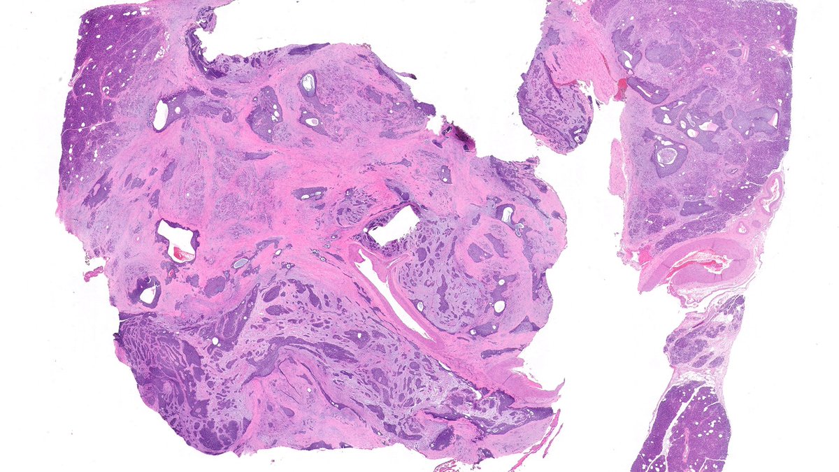 Vik_deshpandeMD's tweet image. Oh Boy! This is a stunner.  Pancreatic tumor. Youngish person. Diffusely keratin positive. Was called a poorly differentiated carcinoma. Sounds reasonable? #GIpath