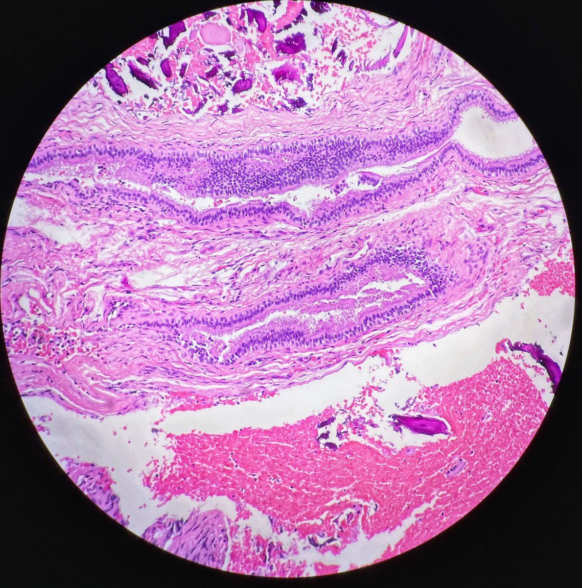 BelknapAustin's tweet photo. Patient is in his 50s with multiple cystic lesions in the maxilla and mandible. He reports orthognathic surgery 25 years ago. Such a great case! #UF #UForalpath #HandNpathology #oralsurgery 🔬🧡💙 https://t.co/3bzBH57BIX