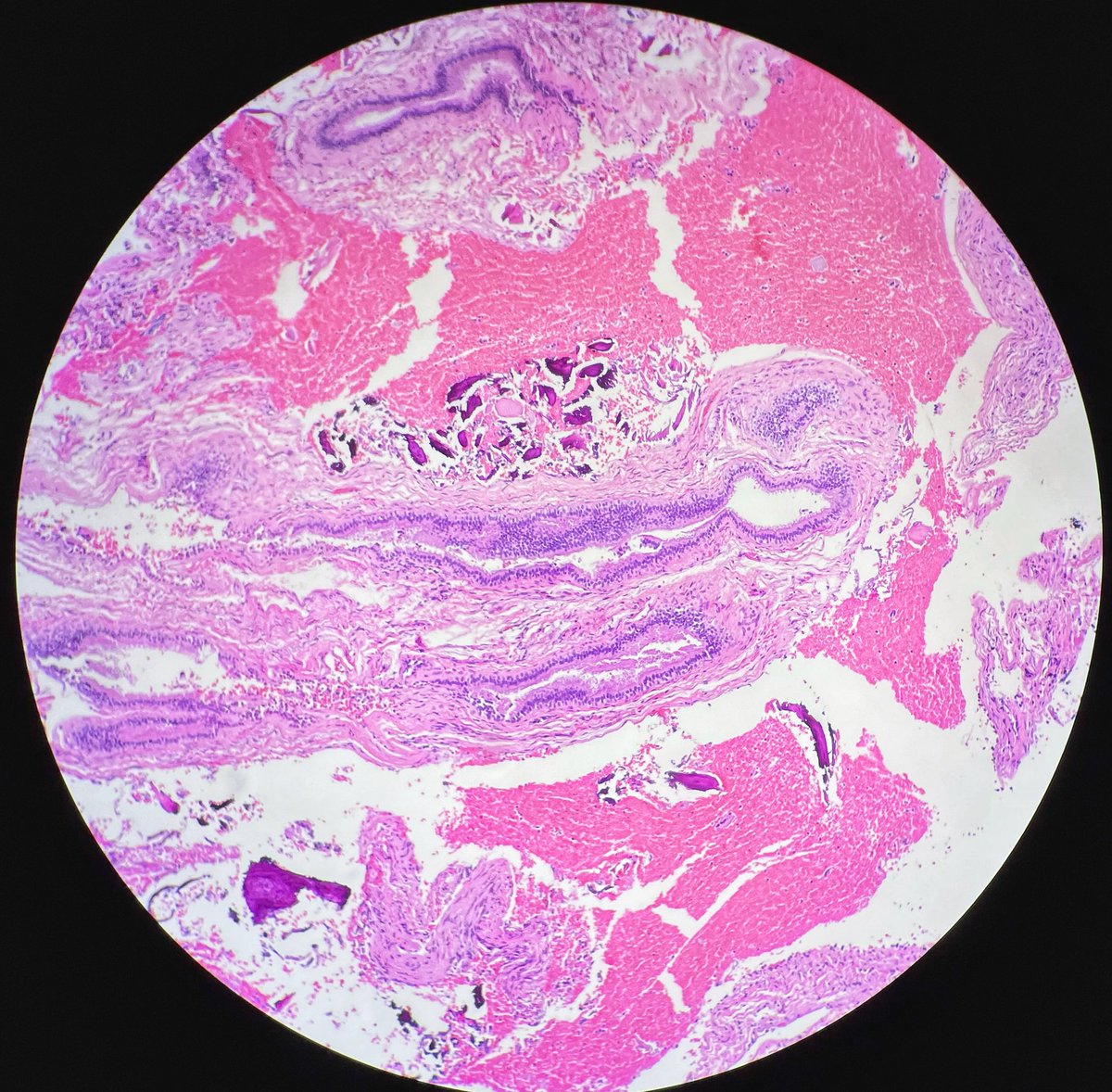 BelknapAustin's tweet photo. Patient is in his 50s with multiple cystic lesions in the maxilla and mandible. He reports orthognathic surgery 25 years ago. Such a great case! #UF #UForalpath #HandNpathology #oralsurgery 🔬🧡💙 https://t.co/3bzBH57BIX
