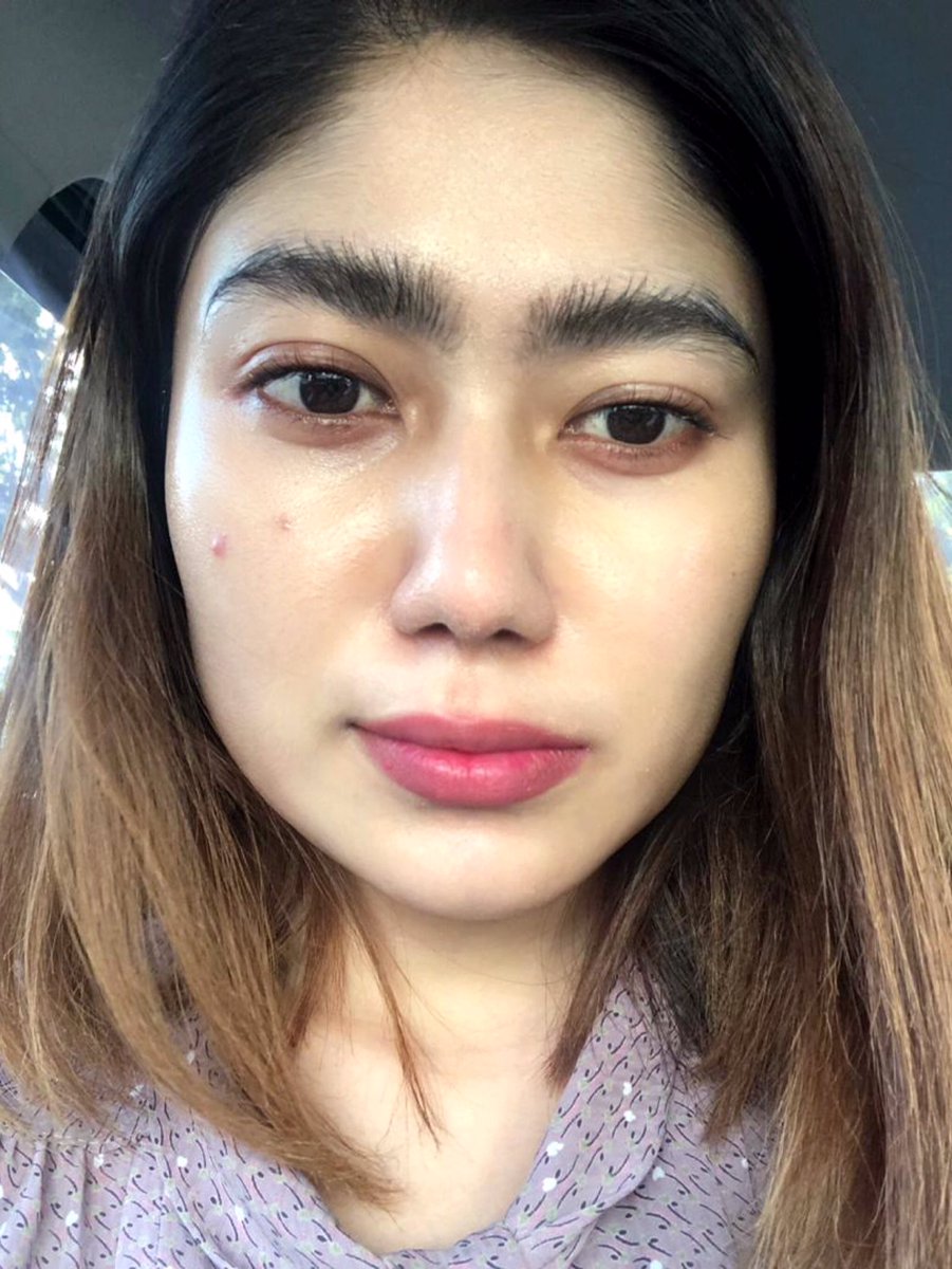 miranoordin's tweet photo. Ahhhhh, I cant thank @kaymanbeauty @NabellaAnuar enough for this holy grail skincare! Look at my skin now after one week of using @kaymanbeauty @kaymanreview 
The first picture was taken last week on Sunday my skin suddenly ada acne back to back. N the 2cnd picture today picture! https://t.co/ypx48eRXvQ