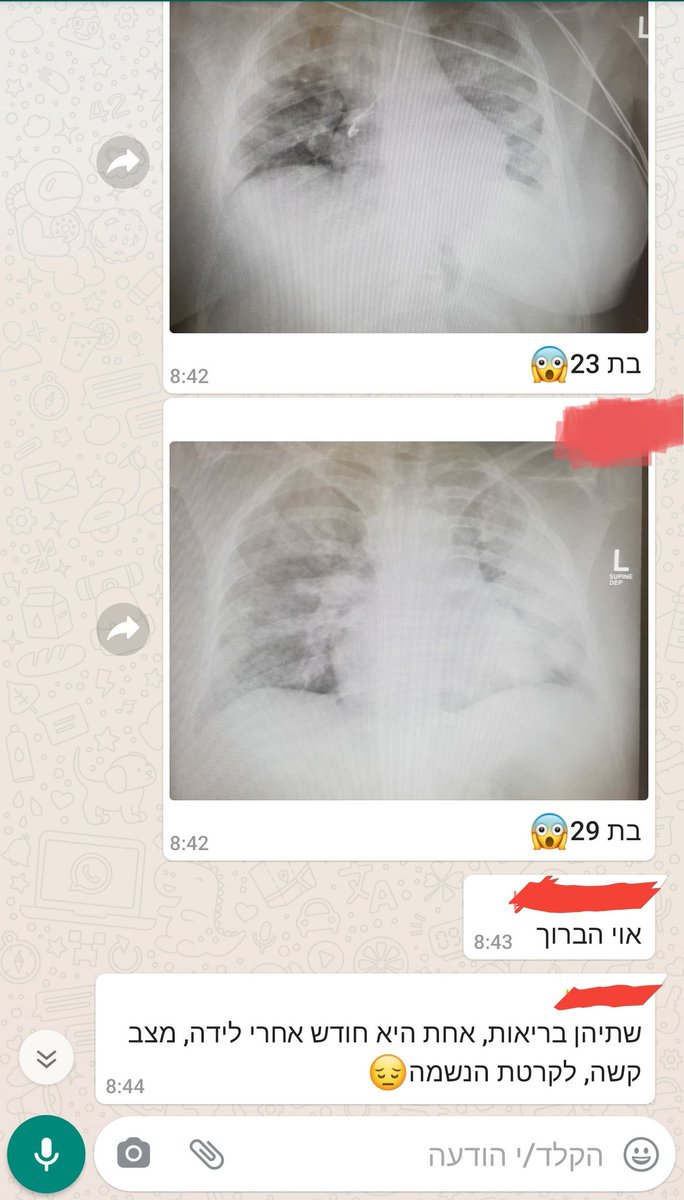 צלום מסך מתוך קבוצת ווטסאפ של מתמחים.

התכתבות על צלומי חזה מחרידים של 2 נשים צעירות ובריאות. 
שיהיה ברור: הרופאים לא ראו כזה דבר כמו הקורונה בימי חייהם.

ככה נראת הקורונה באמת בלי תווך, וככה היא משפיעה על חלק מהחולים.

ואני לא רוצה לחשוב מה היה קורה לנו אם לא היו הגבלות.