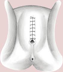 Just IN: Virginity Repair - WHY?🤦🏽‍♀️
SWEDEN: The Swedish Association for Sexuality Education (RFSU) has issued a warning call over clinics offering hymen restoration procedures to girls.
Hymen restoration, also referred to as “virginity repair”, rests on the notion that bride must