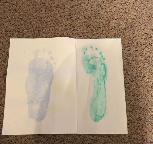 HyProCure's tweet photo. “My footprint before and after my operation. The difference is absolutely insane 😱 hopefully after 25 years of pain I might be nearly fixed once I’m recovered 😭 #hyprocure #amazing #flatfeet #ehlersdanlossyndrome “
📷: @amylmoorhouse
 #footpain #flatfeet #fallenarches #heelpain https://t.co/sQ78A7fylR